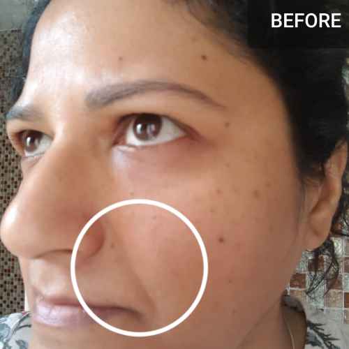 before application of mask